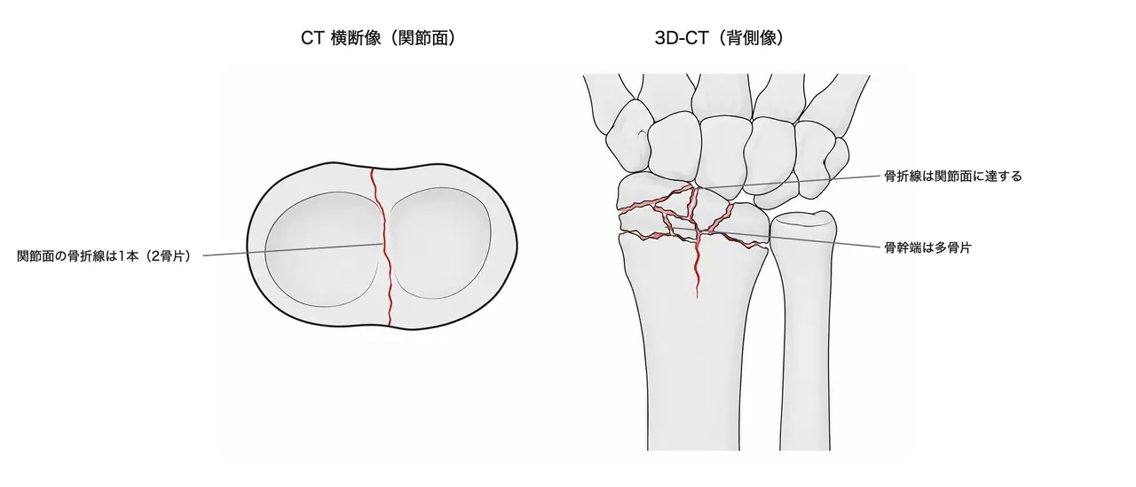 CT横断面・3D再構成 — 関節面を割る骨折線は1本（2骨片）、骨幹端は多骨片。骨片数と月状骨窩-舟状骨窩の転位量を三次元評価する