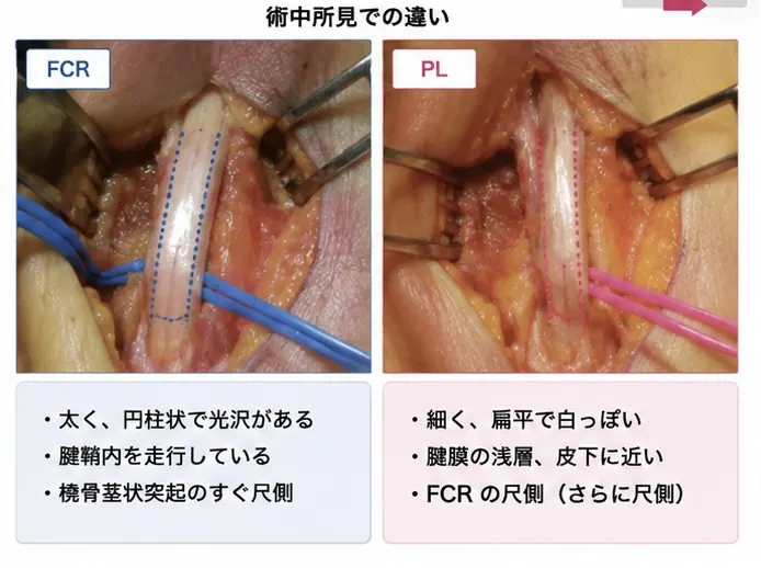 FCRとPLの術中所見の違い — FCRは太く円柱状で光沢があり、腱鞘内を走行し、橈骨茎状突起のすぐ尺側。PLは細く扁平で白っぽく、腱膜の浅層・皮下に近く、FCRのさらに尺側にある