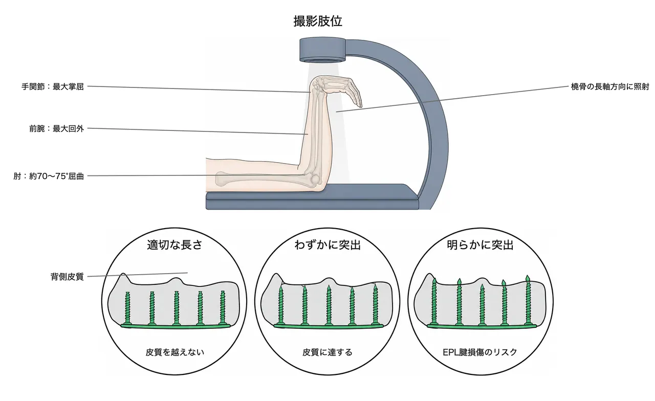 Skyline view の撮影肢位と読み方 — 前腕最大回外・手関節最大掌屈・肘70〜75°屈曲。背側皮質を接線方向に描出し、スクリュー先端の背側突出（EPL腱損傷リスク）を判定する