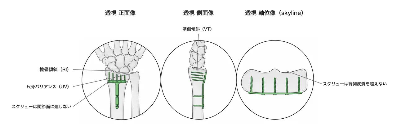 掌側ロッキングプレート設置後の術中透視（正面・側面・軸位） — プレート位置・ロッキングスクリュー配置・橈骨傾斜・尺骨バリアンス・スクリュー先端位置を確認