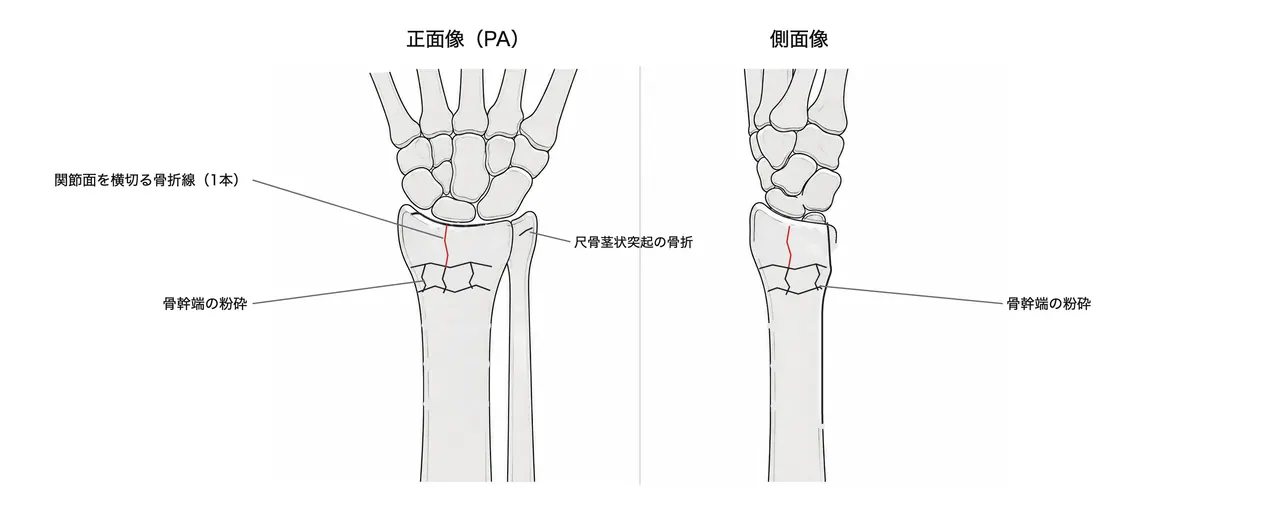 術前X線正面像・側面像 — 関節面を横切る骨折線は1本（2骨片）、骨幹端は粉砕、尺骨茎状突起骨折を伴う。橈骨短縮・掌側傾斜・橈骨傾斜を計測する