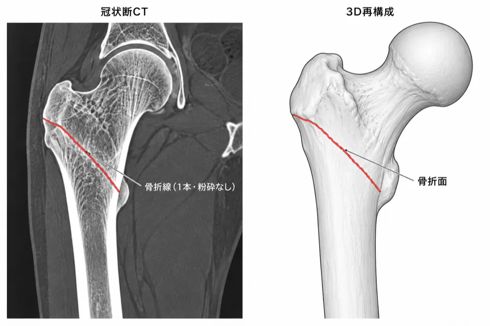 CT冠状断（骨条件 + 3D再構成）