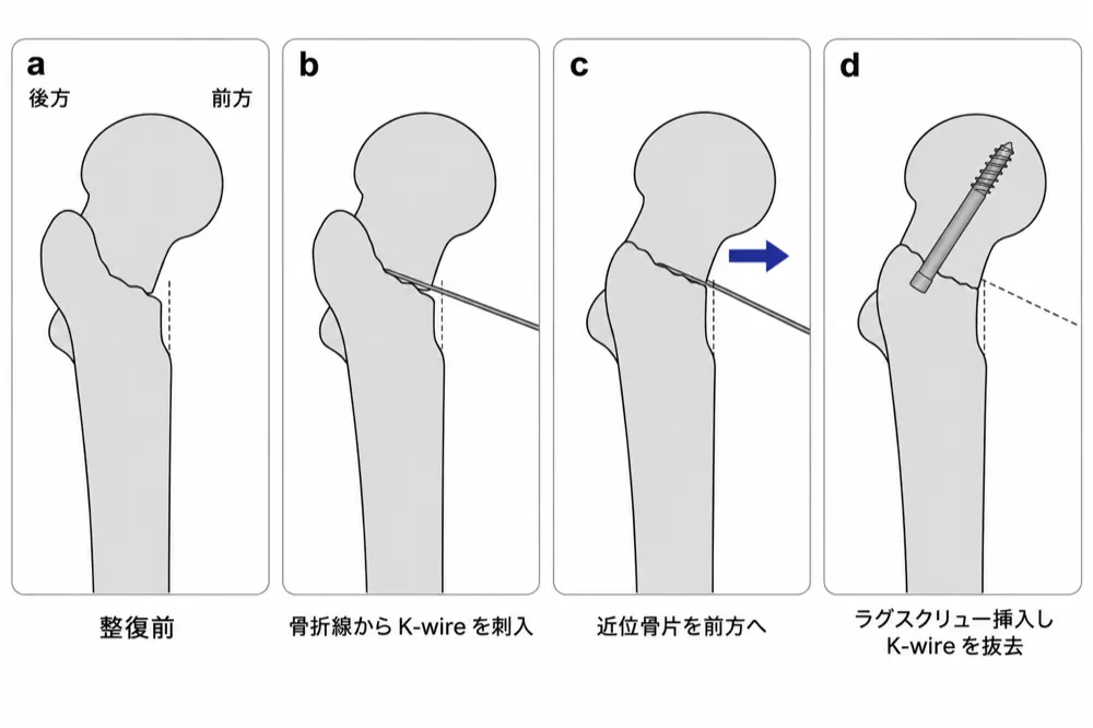intrafocal pinning（側面）— a 整復前／b 骨折線から K-wire を刺入／c 近位骨片を前方へ移動／d ラグスクリュー挿入後に K-wire を抜去