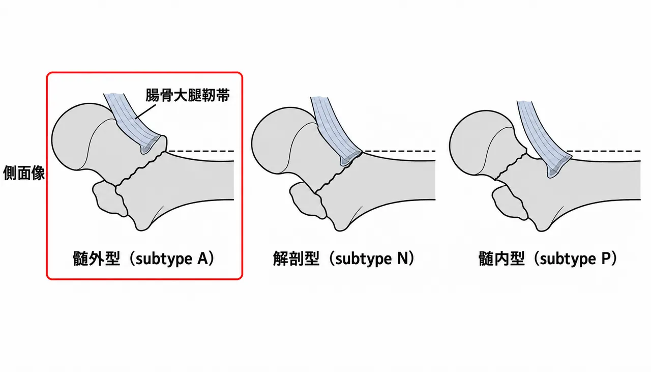 整復位の評価（側面像）— 腸骨大腿靱帯の付着部と骨折線の位置で転位の形が決まる。付着部より遠位＝髄外型（subtype A）／付着部をまたぐ＝解剖型（subtype N）／付着部より近位＝髄内型（subtype P）。目標は髄外型