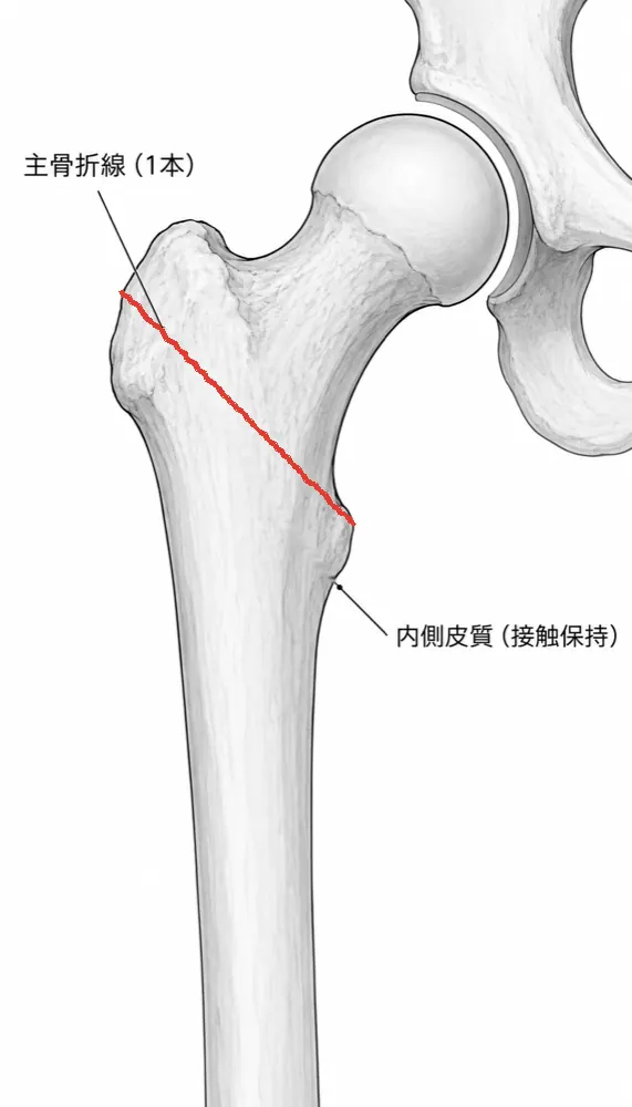 X線正面像 — 骨折線・転位・短縮の確認