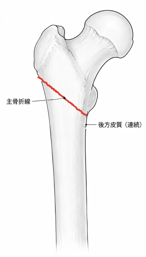 X線側面像 — 矢状面方向の転位評価
