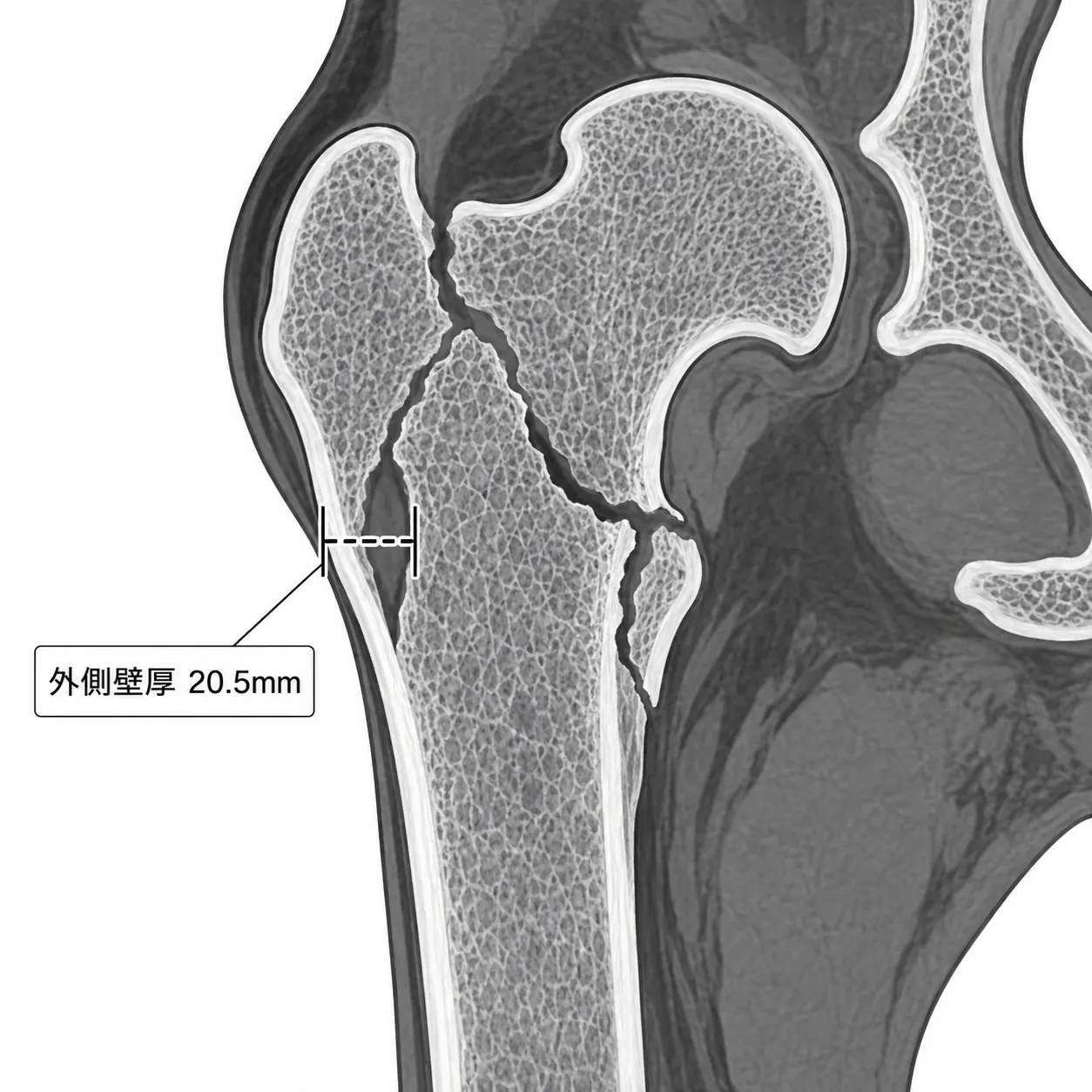 CT冠状断 — 外側壁厚の計測（20.5mm基準）
