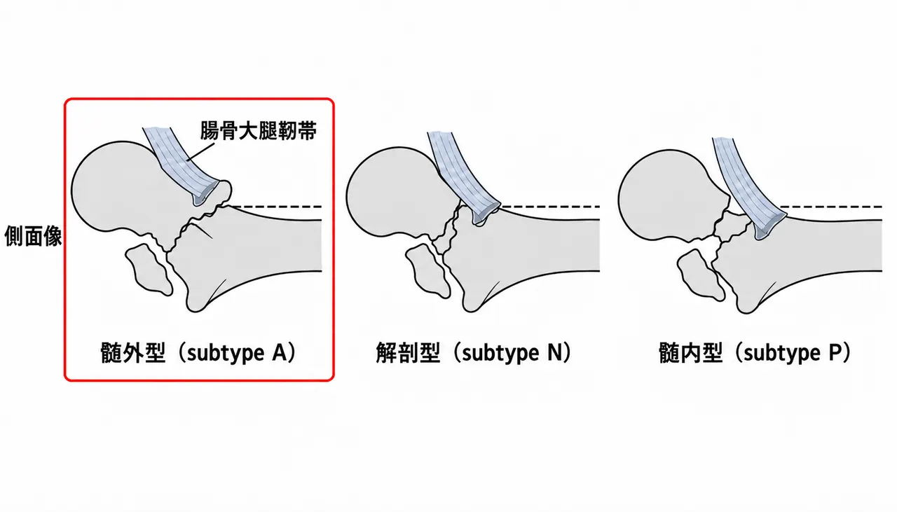 整復位の評価（側面像）— 腸骨大腿靱帯の付着部と骨折線の位置で転位の形が決まる。付着部より遠位＝髄外型（subtype A）／付着部をまたぐ＝解剖型（subtype N）／付着部より近位＝髄内型（subtype P）。目標は髄外型