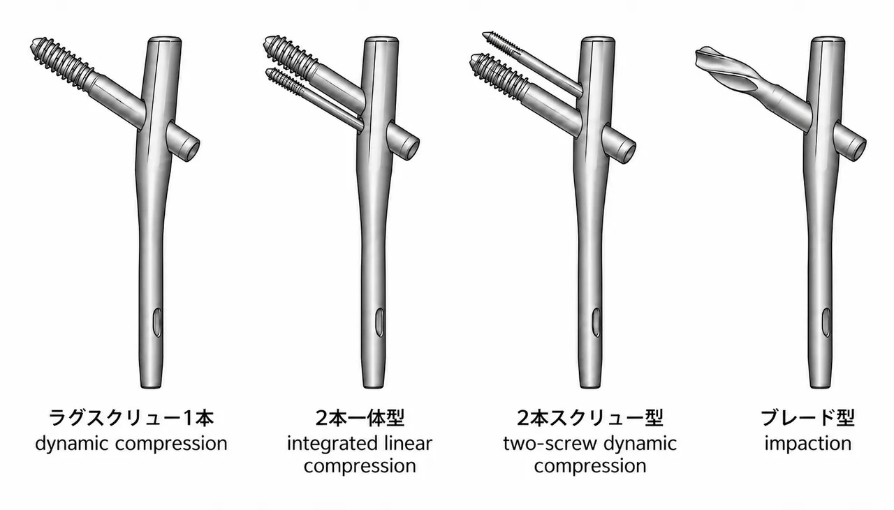 髄内釘（ショートフェモラールネイル）の形の違い — 骨頭に入れる部品がラグスクリュー1本／2本一体型／2本スクリュー型／ブレード型