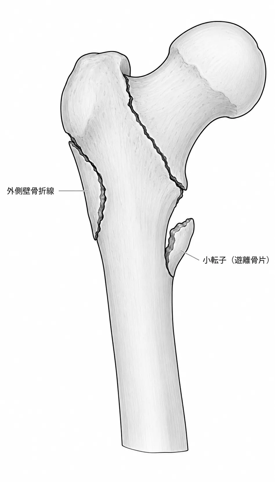 X線正面像 — 外側壁骨折線・遊離小転子の確認