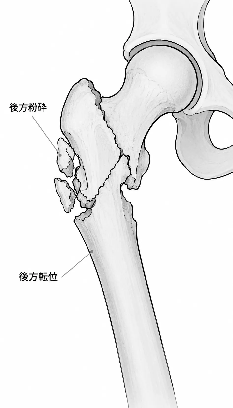 X線側面像 — 矢状面方向の転位・後方粉砕の評価
