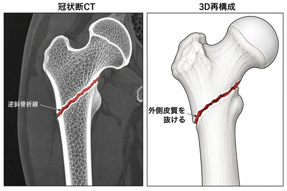 CT（冠状断・3D再構成）— 逆斜骨折線が外側皮質を抜ける。3D-CT で外側の骨折線（LFL）の走行を見て二村分類の型を決める