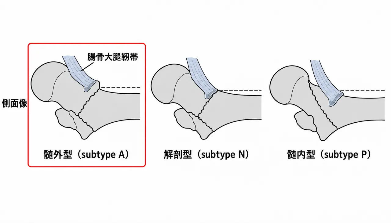 Type I の整復位の評価（側面像）— 腸骨大腿靱帯の付着部と骨折線の位置で転位の形が決まる。付着部より遠位＝髄外型（subtype A）／付着部をまたぐ＝解剖型（subtype N）／付着部より近位＝髄内型（subtype P）。目標は髄外型