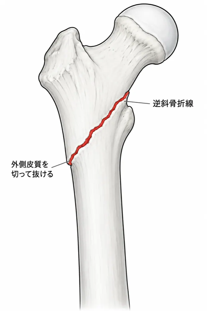 X線正面像 — 逆斜骨折線が外側皮質を抜け、近位内側へ走って小転子の上で内側皮質を抜ける