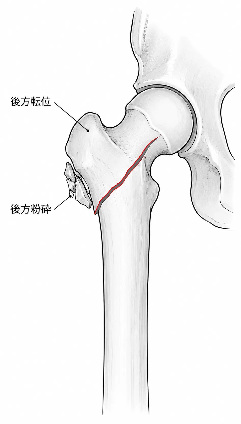 X線側面像 — 矢状面方向の転位評価