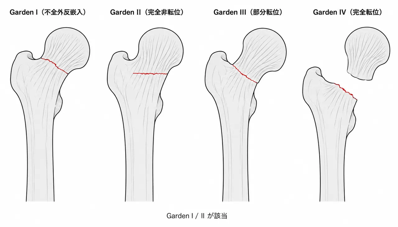 Garden分類 — I〜IVの転位段階（31-B1はI/II）