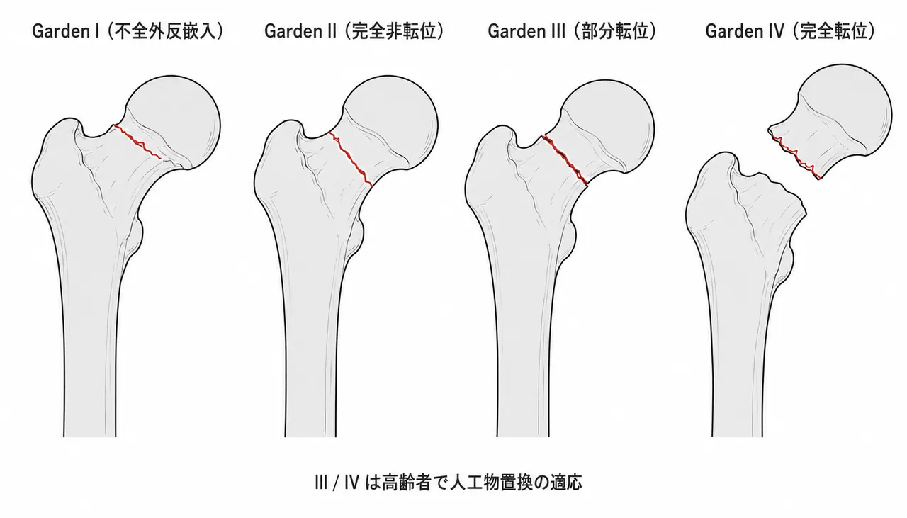 Garden分類 — I〜IVの転位段階（III/IVは高齢者で人工物置換の適応）