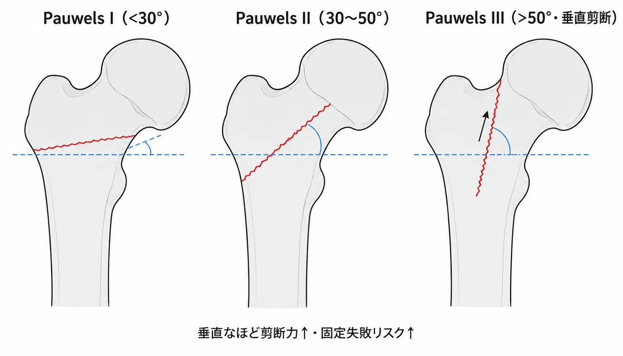 Pauwels分類 — 骨折線角度と剪断力の関係（I〜III）