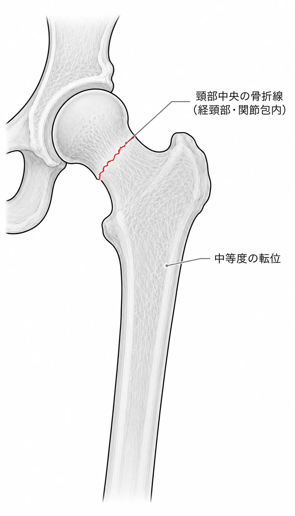 X線正面像 — 経頸部・頸部中央の骨折線