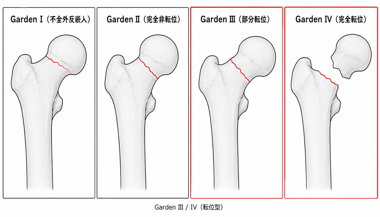 Garden分類 — I〜IV（31-B3はGarden III/IVに概ね相当）