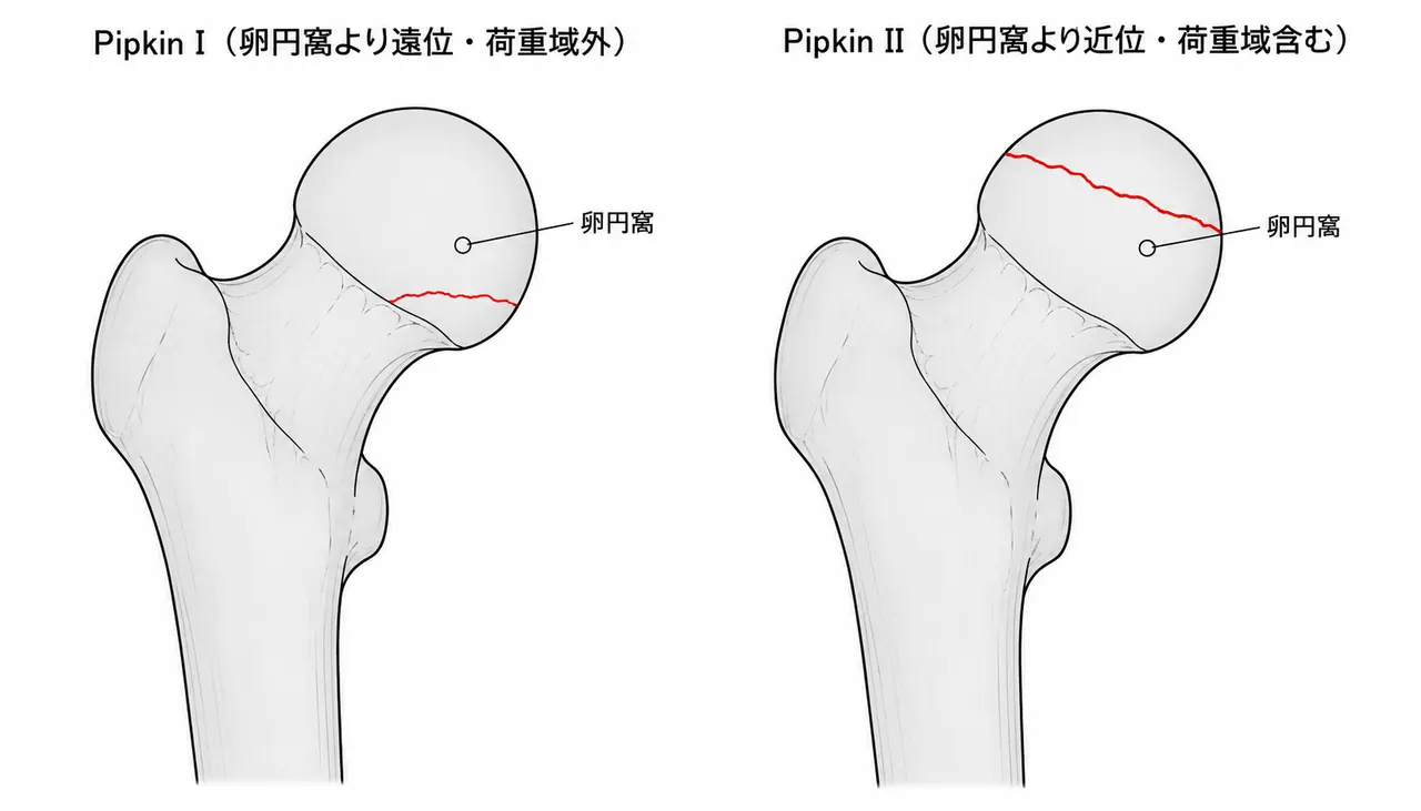 Pipkin分類 — I型（卵円窩遠位・荷重域外）vs II型（近位・荷重域含む）