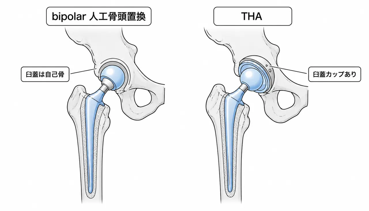 人工物の比較 — bipolar 人工骨頭置換（左）vs 人工股関節全置換術 THA（右）
