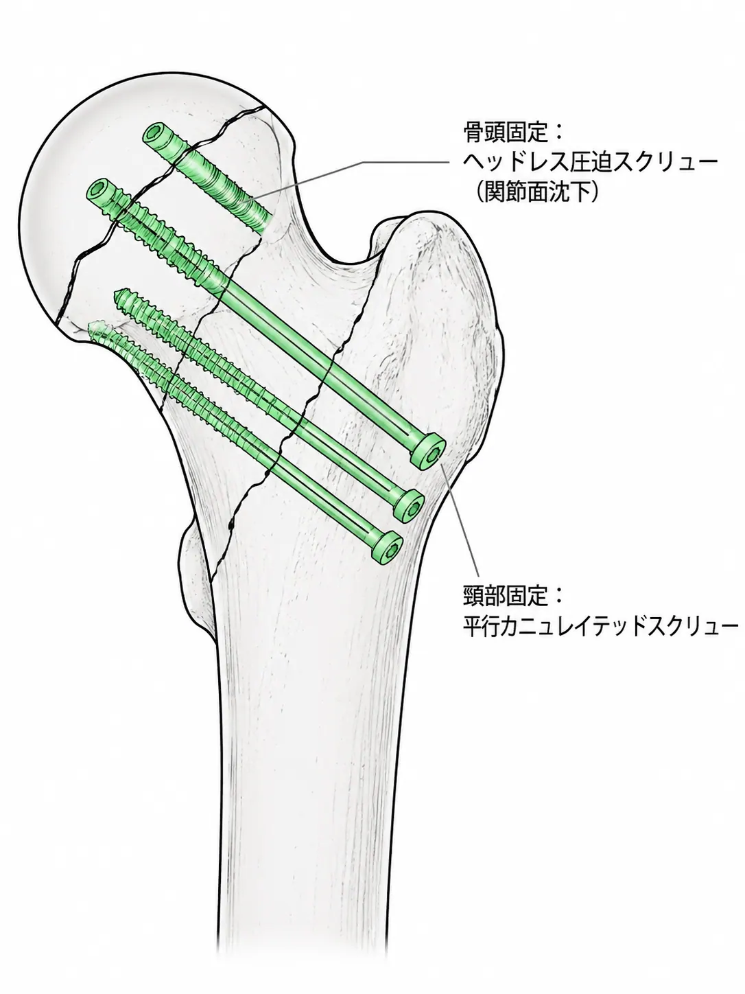 固定構成 — 骨頭ヘッドレス圧迫スクリュー＋頸部平行カニュレイテッドスクリューの二段階固定
