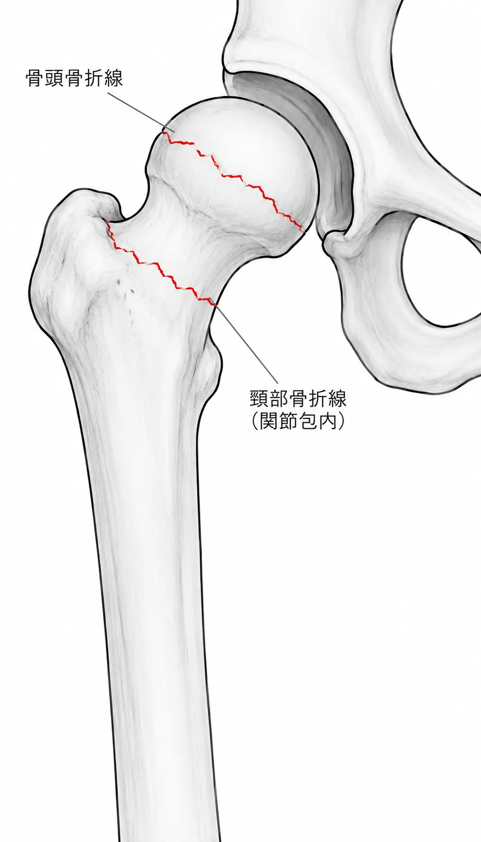 X線正面像 — 骨頭骨折線と頸部骨折線（関節包内）の合併像
