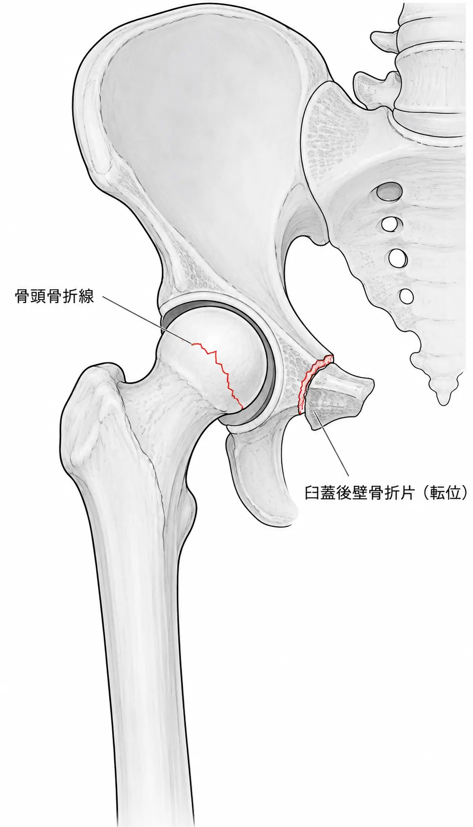 X線正面像 — 骨頭骨折線と臼蓋後壁骨折片（転位）の合併像