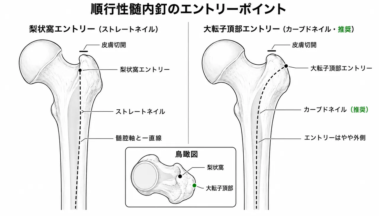 エントリーポイント — 梨状筋窩（直型ネイル）vs 大転子先端（近位彎曲ネイル）