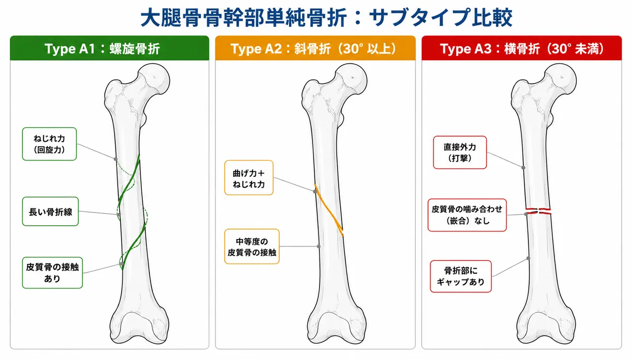 骨折パターン比較 — 32-A1（螺旋）vs 32-A2（斜骨折）vs 32-A3（横骨折）