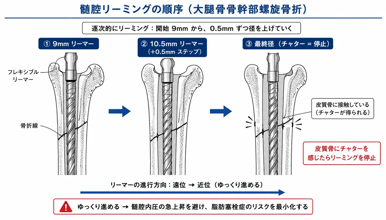 リーミング（段階的拡髄）— 9mmから0.5mm刻み、チャター感で停止