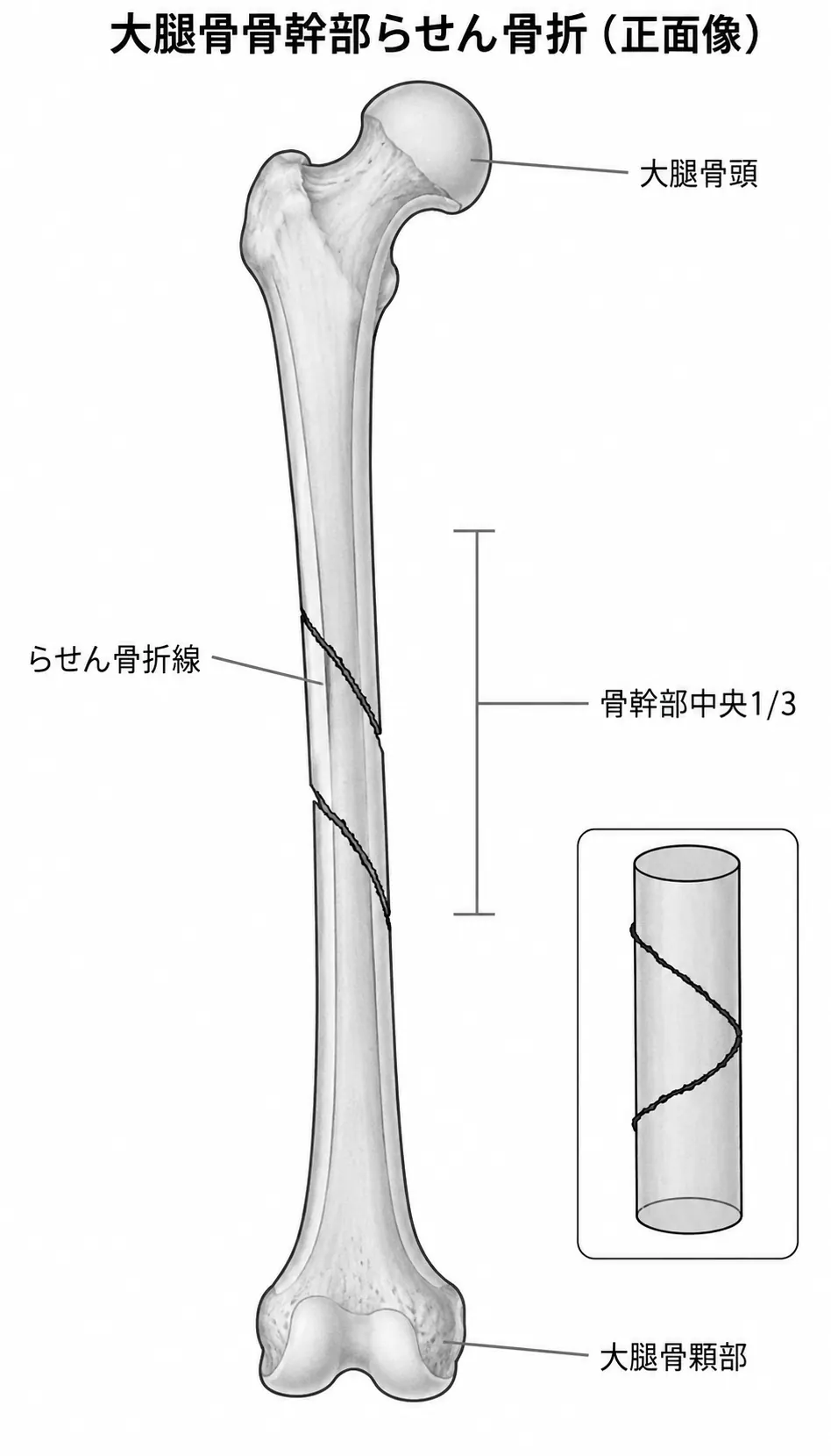 X線正面像 — 大腿骨骨幹部螺旋骨折パターン（中央1/3）