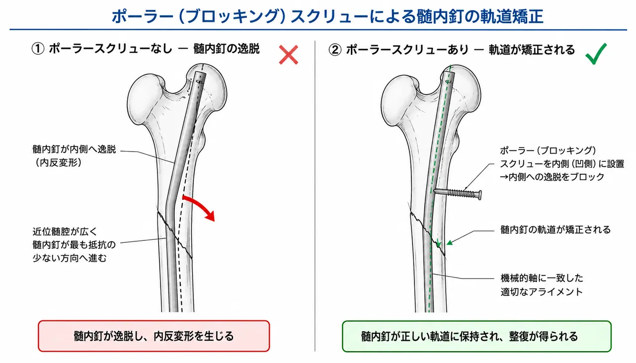 ポーラースクリュー（Blocking screw）— 骨折のconcave側に配置し髄内釘の軌道を矯正
