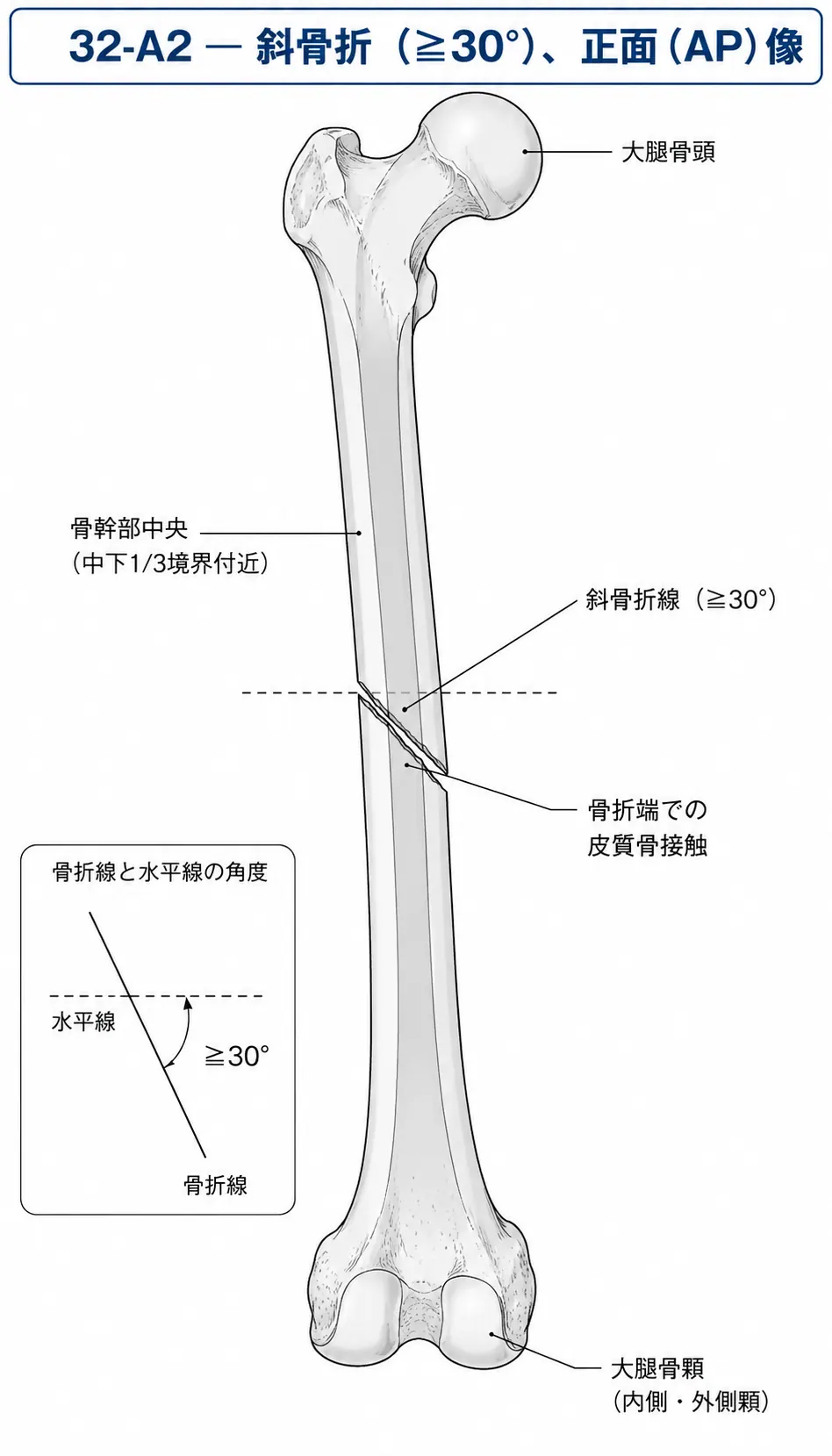X線正面像 — 大腿骨骨幹部斜骨折パターン（≥30°）、骨折端の皮質接触あり