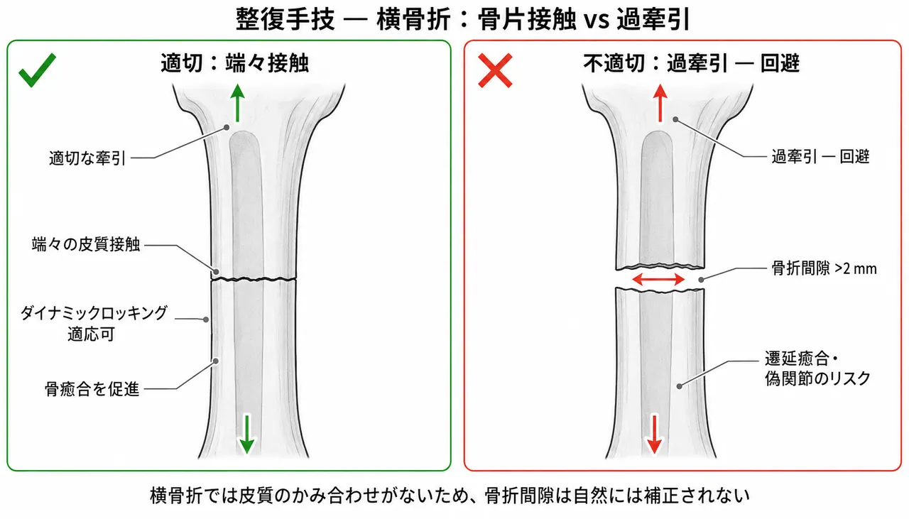 整復手技 — 適正牽引（骨折端接触）vs 過牽引（ギャップ）の比較