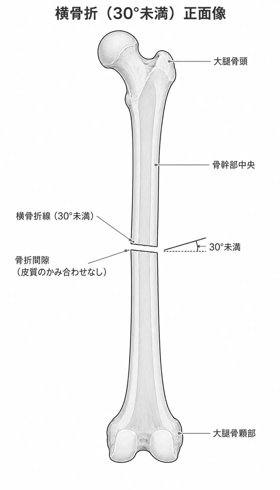 X線正面像 — 大腿骨骨幹部横骨折パターン（<30°）、骨折端のギャップあり