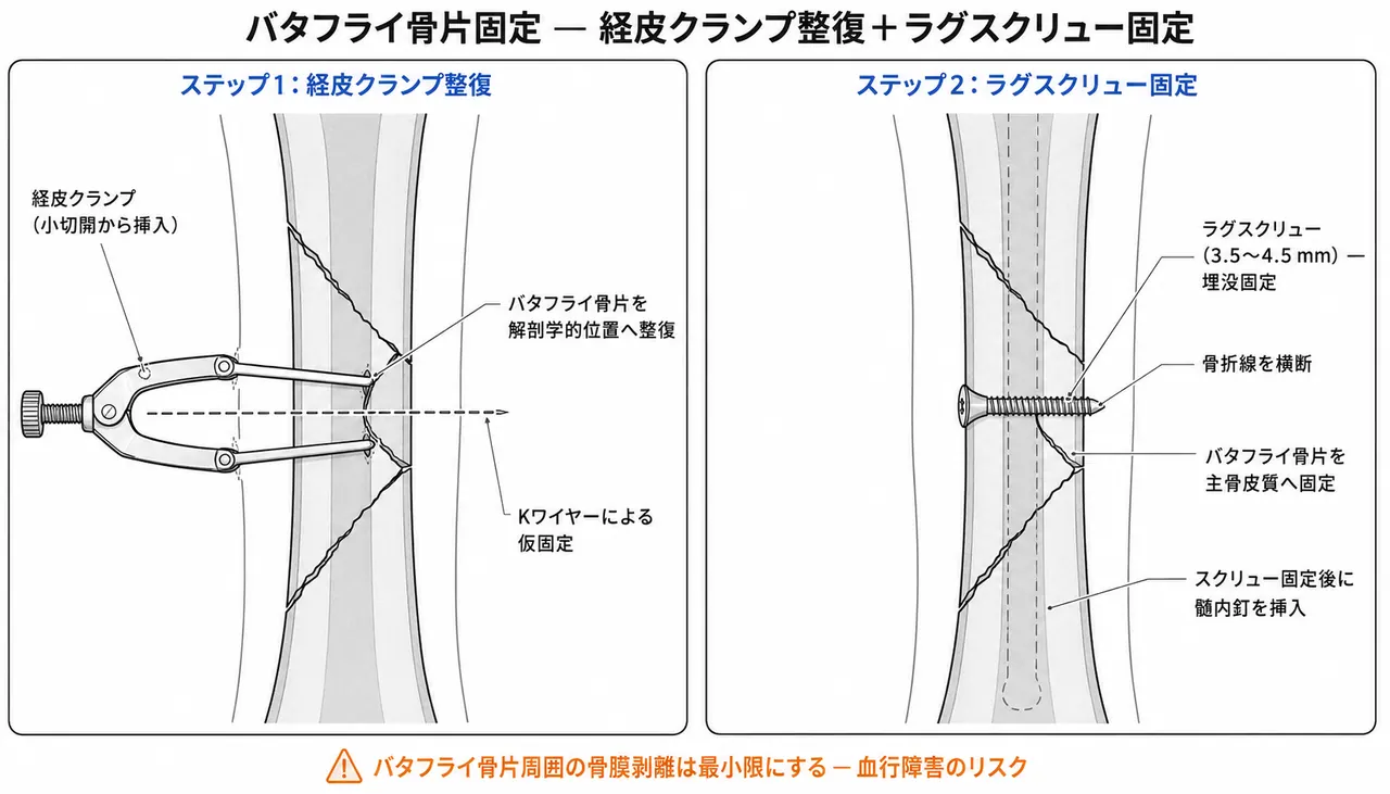 楔状骨片（バタフライ骨片）の経皮的クランプ整復＋ラグスクリュー固定