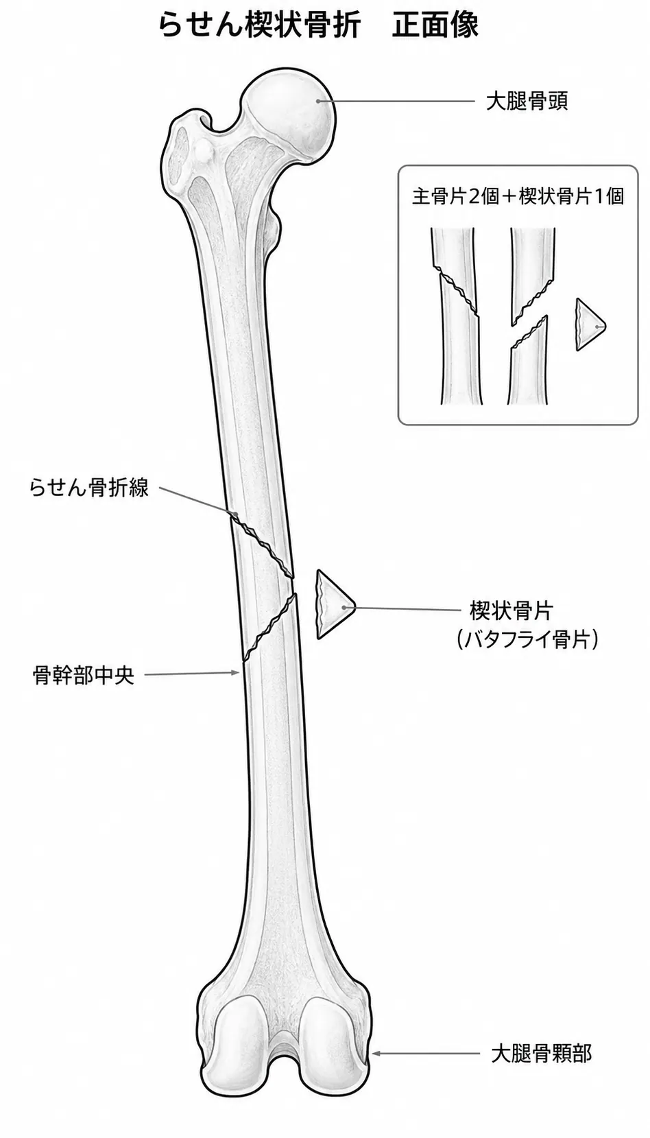 X線正面像 — 螺旋骨折線と楔状（バタフライ）骨片