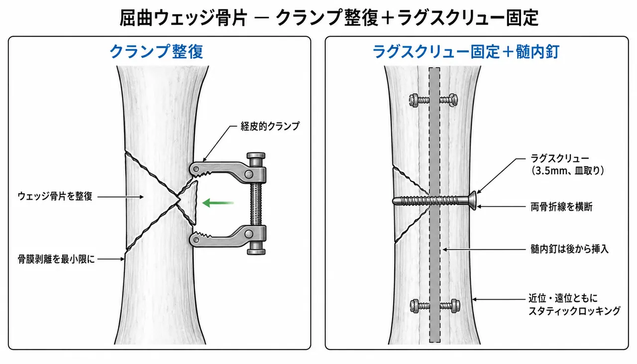 楔状骨片の経皮的クランプ整復＋ラグスクリュー固定