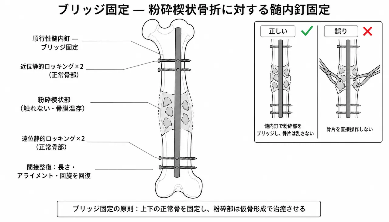 ブリッジ固定の概念 — 粉砕楔型骨折に髄内釘を通し近位・遠位正常骨幹部で固定