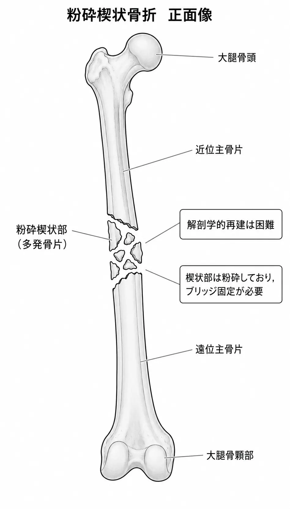X線正面像 — 楔状部位の粉砕（複数骨片）
