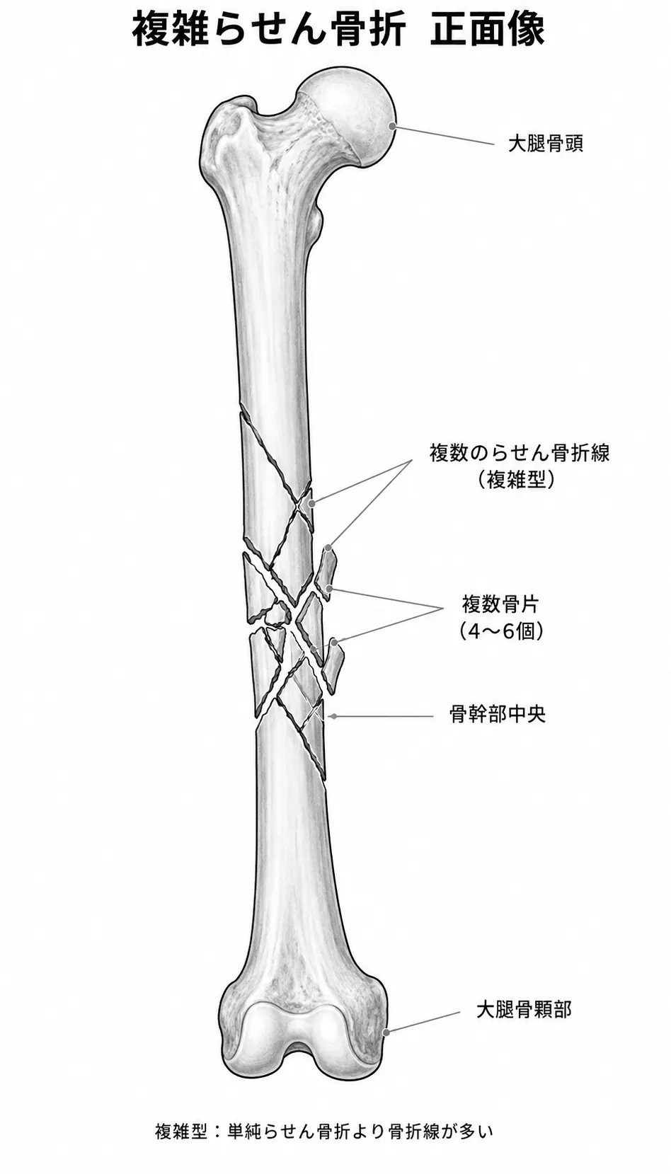 X線正面像 — 複数の螺旋骨折線と多数の骨片