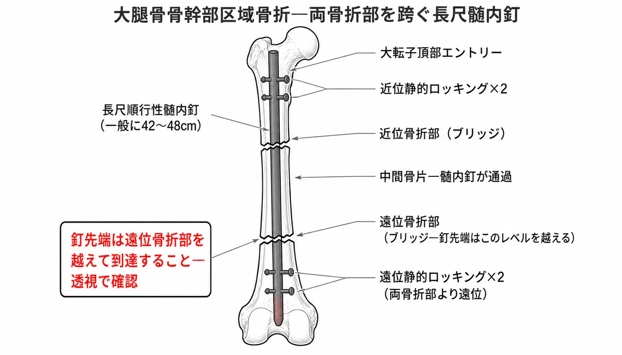 分節型骨折の長い髄内釘固定 — 近位・遠位の両骨折をまたぐ長釘と静的ロッキング4本