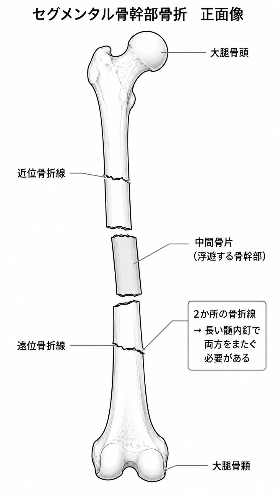 X線正面像 — 2本の骨折線（近位・遠位）と中間骨片（floating segment）