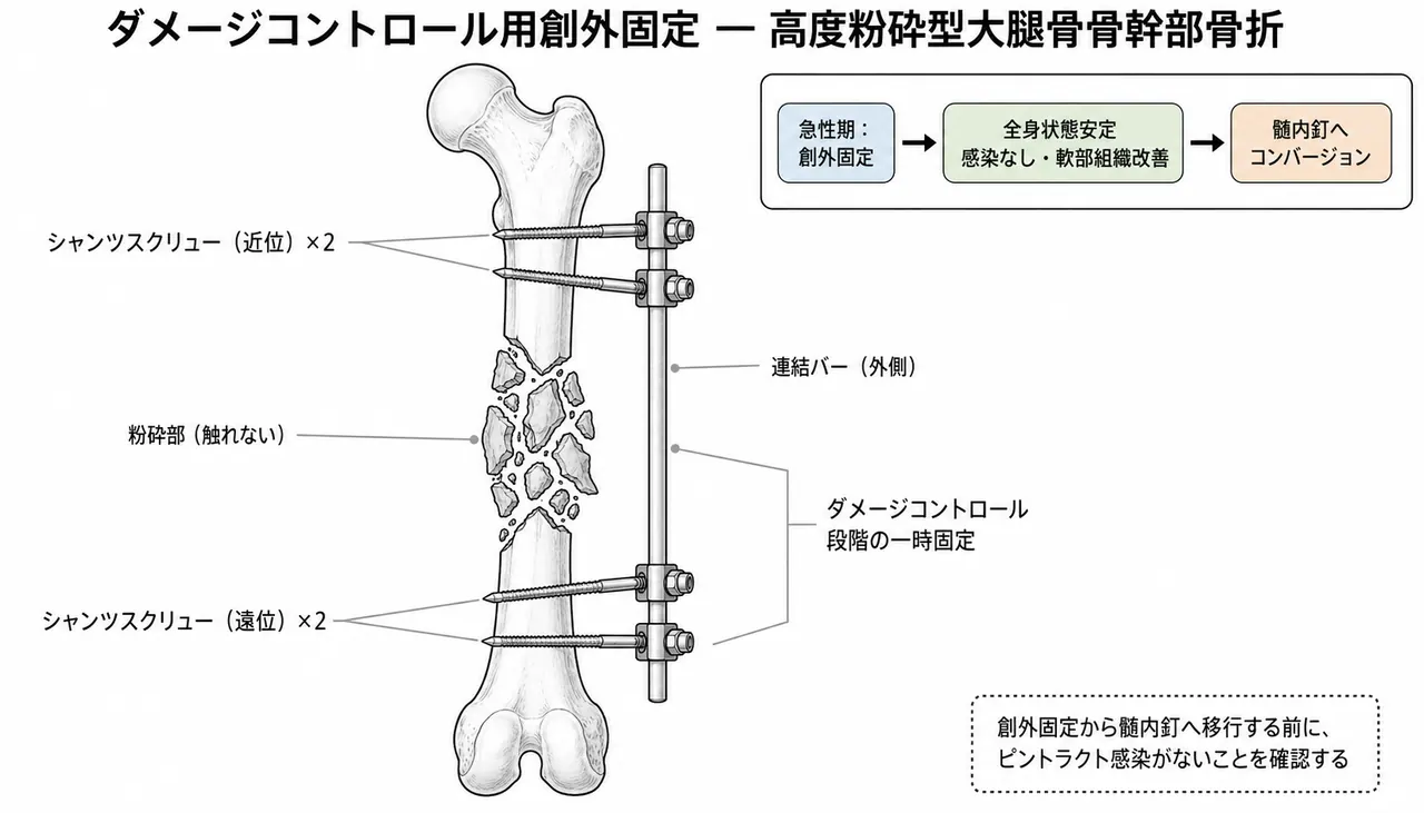 ダメージコントロール（単管創外固定）— 骨幹部近位・遠位正常部にSchanzピンを刺入し仮固定