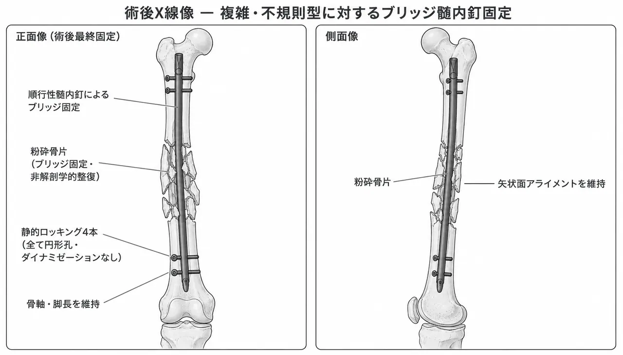 術後X線像（本固定後）— 髄内釘＋静的ロッキング。高度粉砕部を橋渡し