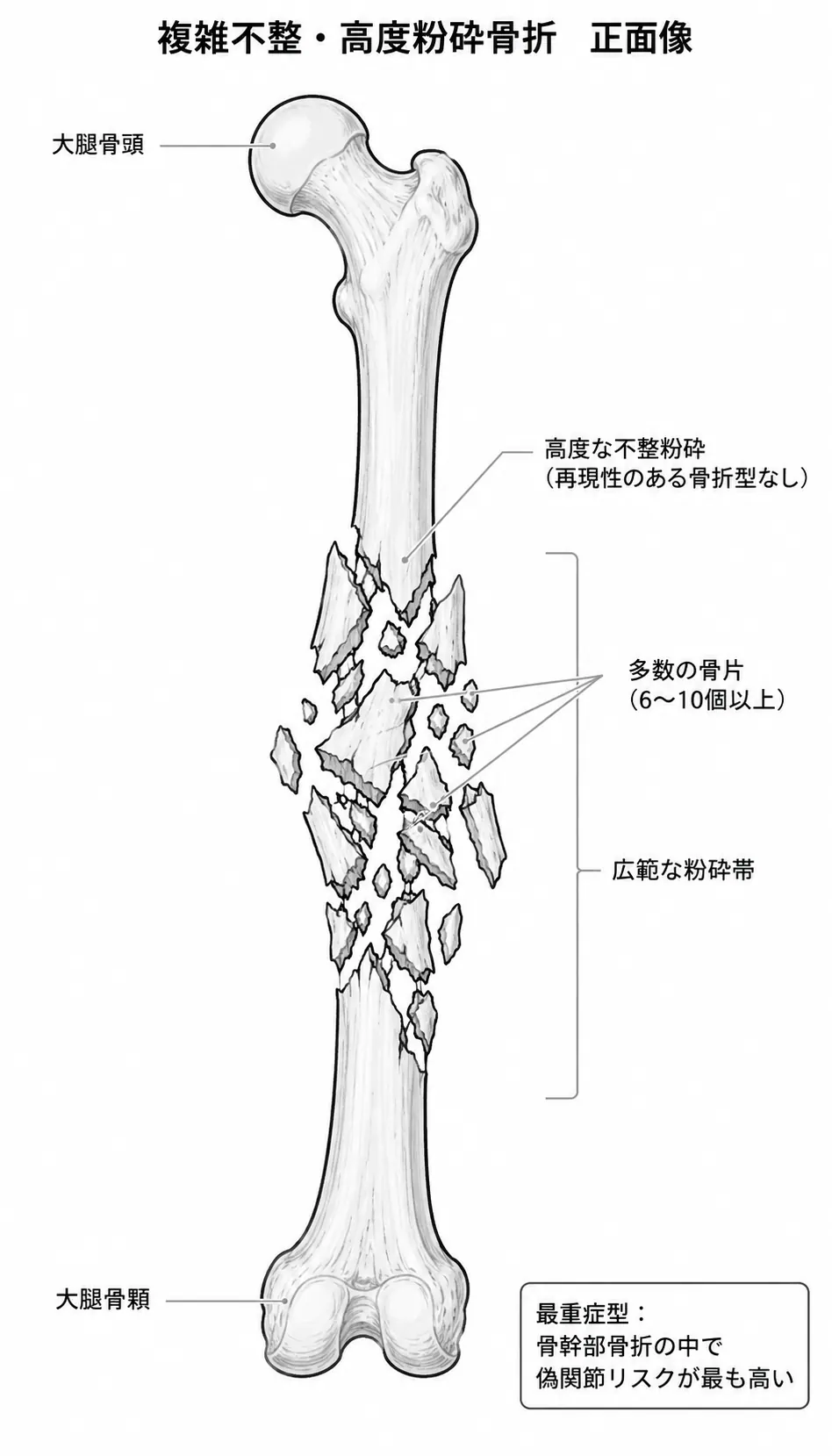 X線正面像 — 骨幹部の高度粉砕（複数の不規則な骨折線と多数の骨片）