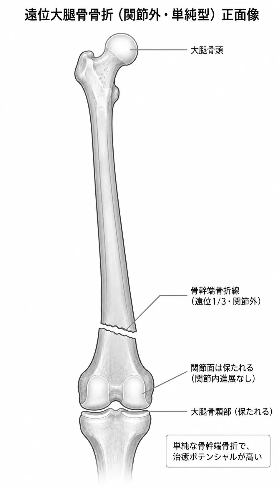X線正面像 — 大腿骨遠位骨幹端に単純横〜斜骨折線。関節面は正常