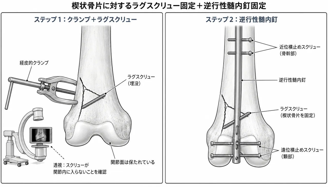 楔状骨片のクランプ整復＋ラグスクリュー固定、その後逆行性IM釘挿入